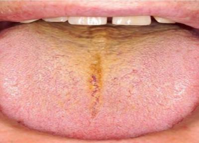 دلایل زرد شدن زبان و ارتباط آن با سایر بیماری ها